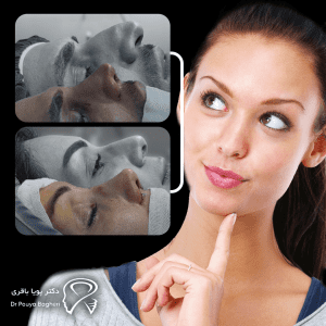 تفاوت جراحی بینی به روش باز و بسته