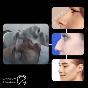 کاربردهای رینوپلاستی بسته