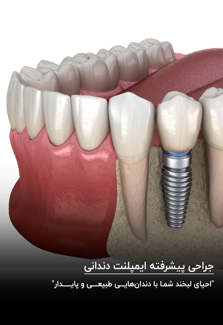 جراحی پیشرفته ایمپلنت دندانی