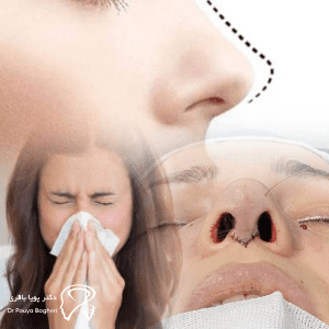 🧬 آیا درمان آلرژی با عمل بینی امکان‌پذیر است؟