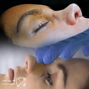 عمل رینوپلاستی چیست؟