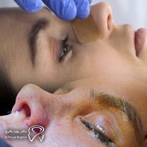 تفاوت جراحی بینی باز و بسته