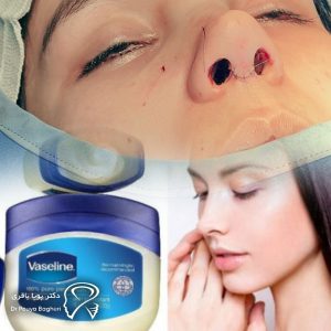 مراقبت از زخم‌های پس از عمل بینی