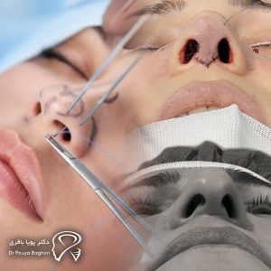 جراحی بینی به روش باز چیست؟