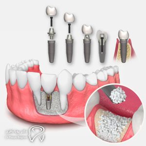 ارزیابی نیاز به جراحی پیوند استخوان