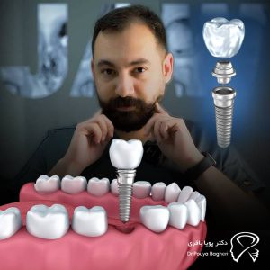 مشاوره اولیه: نقطه شروع کاشت ایمپلنت