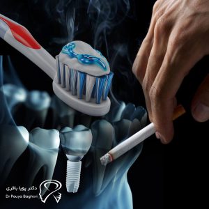 راه های افزایش طول عمر ایمپلنت