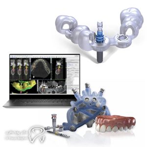 ایمپلنت دیجیتال چیست؟