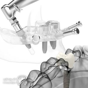 ایمپلنت دیجیتال؛ تحول شگفتانگیز در دندانپزشکی مدرن