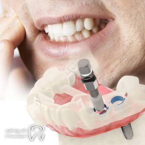 افرادی که عادت به دندانقروچه دارند