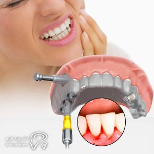 افرادی که مشکلات لثهای دارند