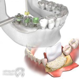 افرادی که تراکم استخوانی کافی ندارند