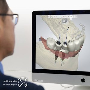طراحی دقیق ایمپلنت با نرمافزارهای دیجیتال