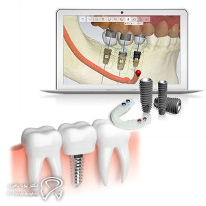 مقایسه ایمپلنت دیجیتال با روش سنتی