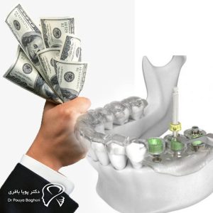 چرا باید ایمپلنت دیجیتال را انتخاب کنیم؟