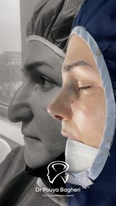 رینوپلاستی بینی گوشتی چیست و آیا واقعاً نتیجه میدهد؟