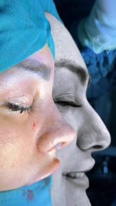 چرا عمل بینی گوشتی میتواند چهره شما را متحول کند؟ مزایایی که شاید ندانید!
