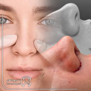 رابطه بین رینوپلاستی و سینوزیت چیست؟