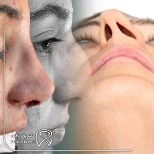 چه کسانی کاندید مناسب عمل همزمان رینوپلاستی و جراحی سینوزیت هستند؟