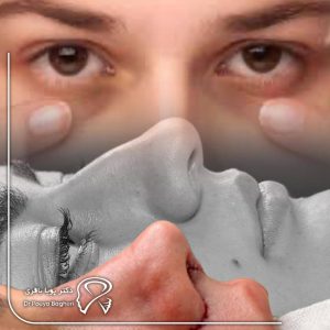 شایع‌ترین عوارض بعد از عمل بینی و راه‌های پیشگیری
