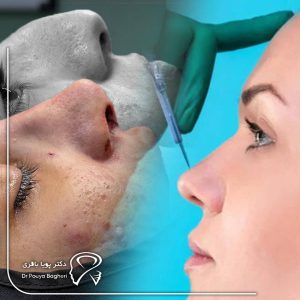 بی‌حسی یا احساس گزگز در نوک بینی