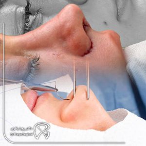 ۵ توصیه طلایی برای پیشگیری از عوارض رینوپلاستی
