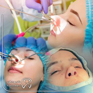 بهترین سن جراحی بینی