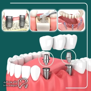 روش جراحی و طراحی ایمپلنت