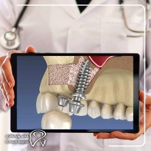 سطح تراکم استخوان فک (Bone Density)