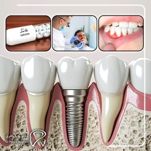 چه چیزهایی احتمال موفقیت ایمپلنت را بیشتر میکنند؟