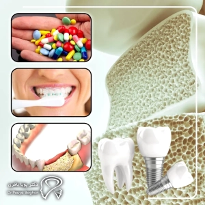 کاشت ایمپلنت با وجود پوکی استخوان: چه باید بدانید؟