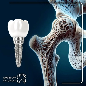 آیا پوکی استخوان مانعی مطلق برای ایمپلنت است؟