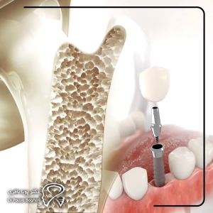 پوکی استخوان بهمعنای حذف ایمپلنت نیست