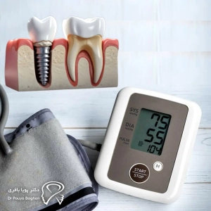 آیا ایمپلنت ممکن است باعث افزایش فشار خون شود؟