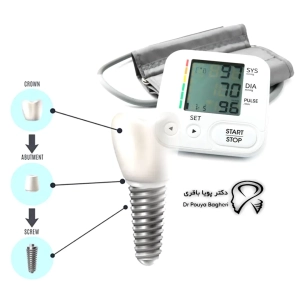 فشار خون بالا و ایمپلنتهای دندانی