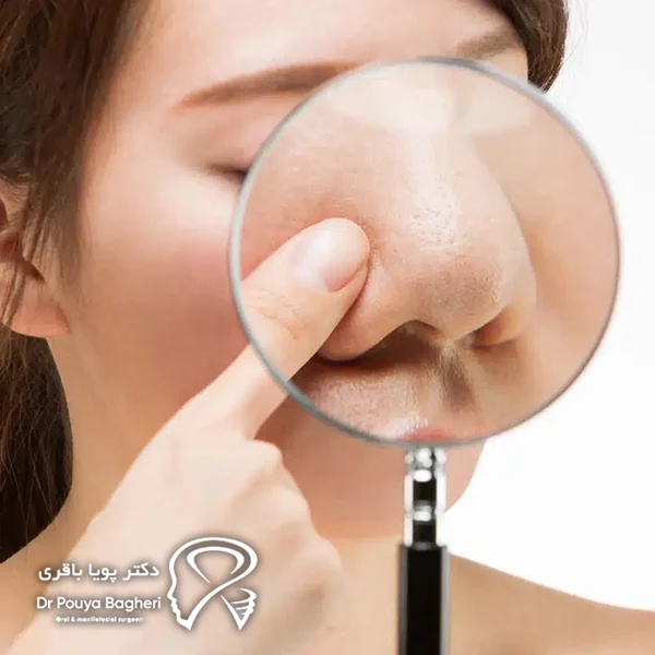 بینی‌های گوشتی و خطر افتادگی