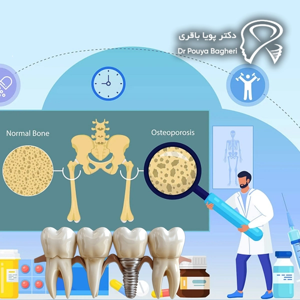آیا مصرف بیس‌فسفونات باعث شکست ایمپلنت می‌شود؟