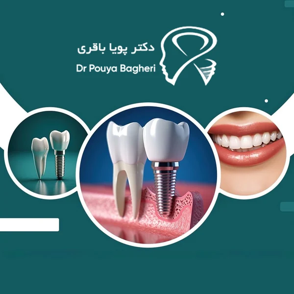 چه کسانی بهتر است ایمپلنت را به تعویق بیندازند؟
