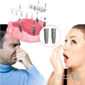 تفاوت بین بوی بد دهان طبیعی و ناشی از ایمپلنت