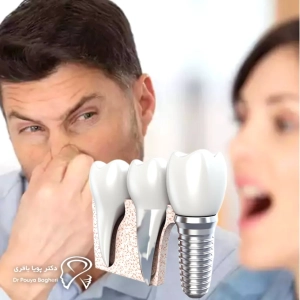 آیا ایمپلنت باعث بوی بد دهان می‌شود؟
