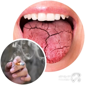 شایع‌ترین دلایل بوی بد دهان بعد از ایمپلنت: