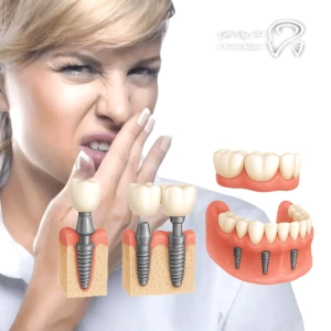 آیا ایمپلنت به‌خودی‌خود بوی بد ایجاد می‌کند؟