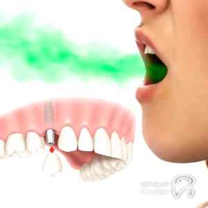 آیا بوی بد به معنی شکست ایمپلنت است؟