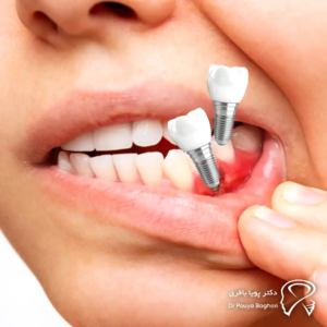 چرا شناخت علائم عفونت ایمپلنت اهمیت دارد؟