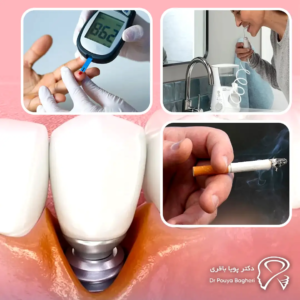 چگونه از عفونت ایمپلنت پیشگیری کنیم؟
