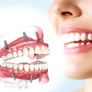 چه مدت بعد از کشیدن دندان میتوان ایمپلنت کرد؟