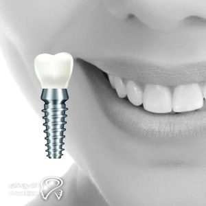 چرا زمان‌بندی ایمپلنت بعد از کشیدن دندان مهم است؟ ⏳