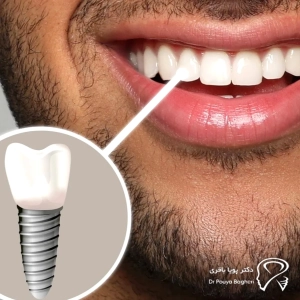 چرا زمان‌بندی ایمپلنت بعد از کشیدن دندان مهم است؟