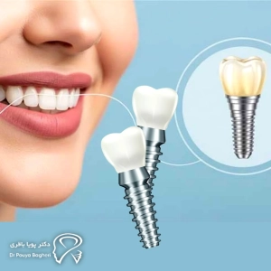 چرا برخی بیماران به ایمپلنت فوری تمایل دارند؟