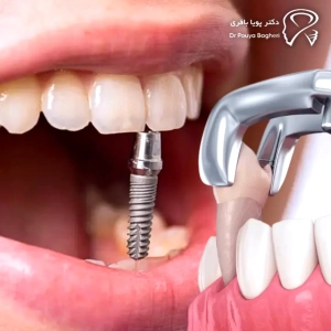 چه مدت بعد از کشیدن دندان باید ایمپلنت کرد؟ ⏳